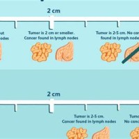 Brain Tumor Size Chart Cm