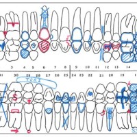 Dental Charting Symbols Restorations