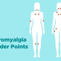 Fibromyalgia 18 Tender Points Chart