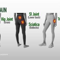 Hip Pain Location Chart