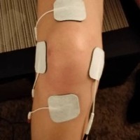 Knee Pain Tens Unit Pad Placement Chart