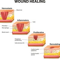 Phases Of Wound Healing Chart