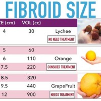 Uterine Fibroid Size Chart In Mm Hindi