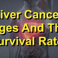 Liver Cancer Life Expectancy Chart