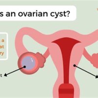 Ovarian Cyst Size Chart In Ml