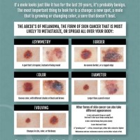 Skin Cancer Check Chart